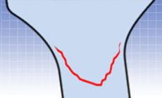 Smile shaped crack